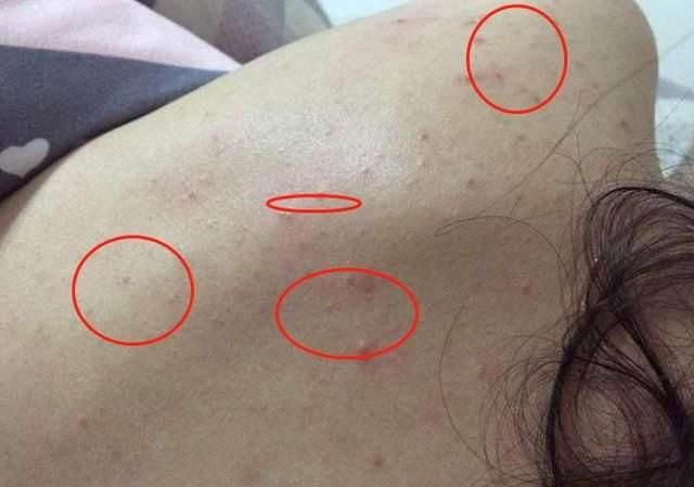 皮膚螨蟲檢測儀檢測皮膚隱形殺手:螨蟲 皮膚螨蟲檢測儀檢測皮膚隱形殺手:螨蟲