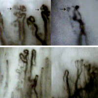 微循環檢測儀檢測甲壁微循環的管袢形態和流態釋義