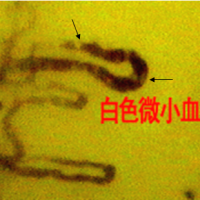 甲襞微循環的白微栓形成過程與檢測意義