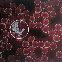 一滴血檢測儀檢測膽固醇結晶