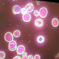 道恩培訓—健康課堂之《靶型紅細胞》